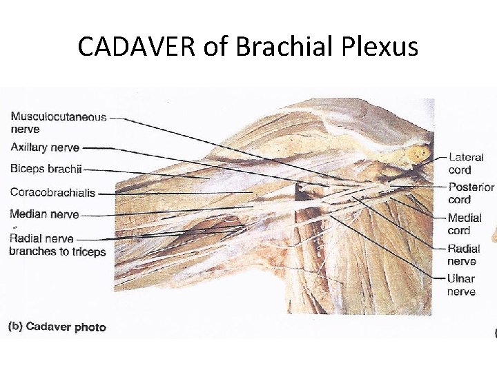 CADAVER of Brachial Plexus 