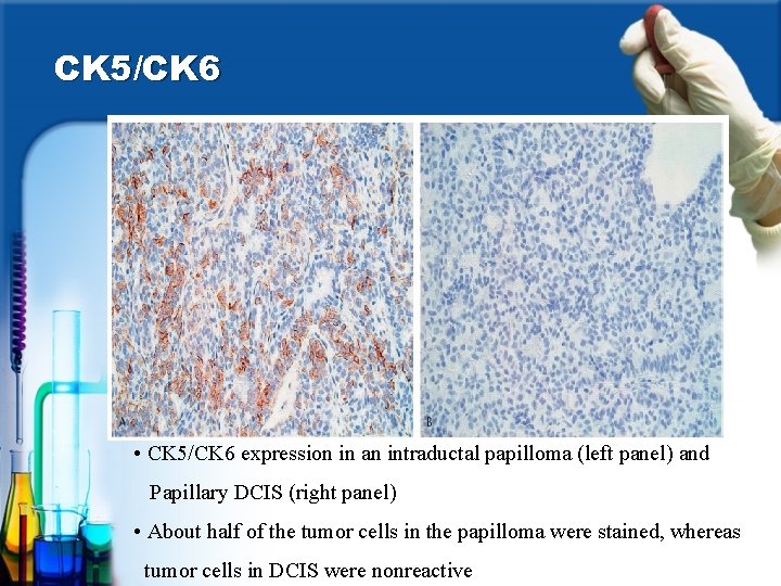 Intraductal papilloma ck5/ 6. Papilloma virus herpes zoster - alexandrudiaconescu.ro