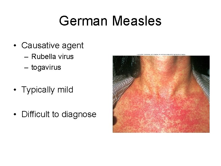 German Measles • Causative agent – Rubella virus – togavirus • Typically mild •