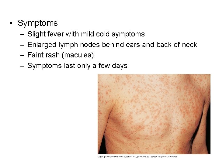  • Symptoms – – Slight fever with mild cold symptoms Enlarged lymph nodes