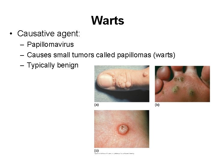 Warts • Causative agent: – Papillomavirus – Causes small tumors called papillomas (warts) –