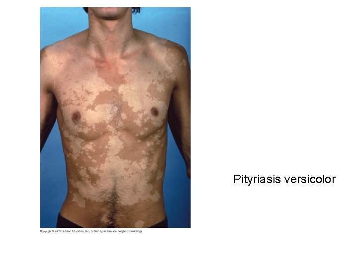 Pityriasis versicolor 