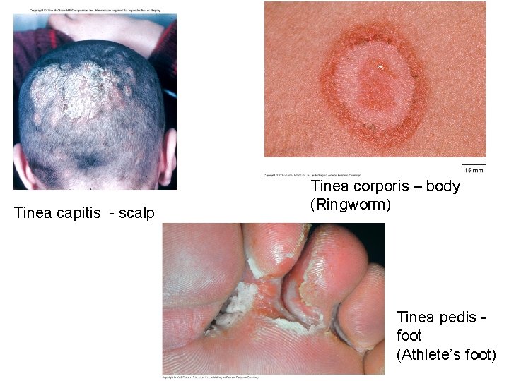 Tinea capitis - scalp Tinea corporis – body (Ringworm) Tinea pedis foot (Athlete’s foot)