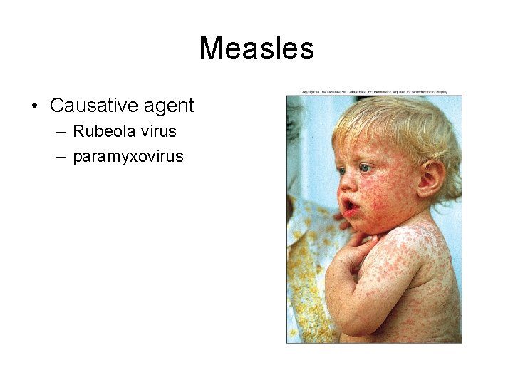 Measles • Causative agent – Rubeola virus – paramyxovirus 