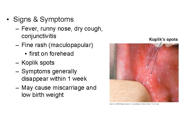  • Signs & Symptoms – Fever, runny nose, dry cough, conjunctivitis – Fine