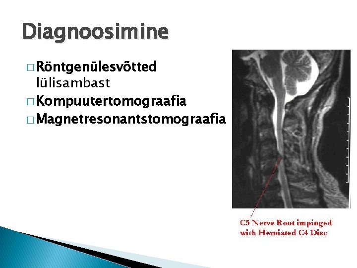 Diagnoosimine � Röntgenülesvõtted lülisambast � Kompuutertomograafia � Magnetresonantstomograafia 