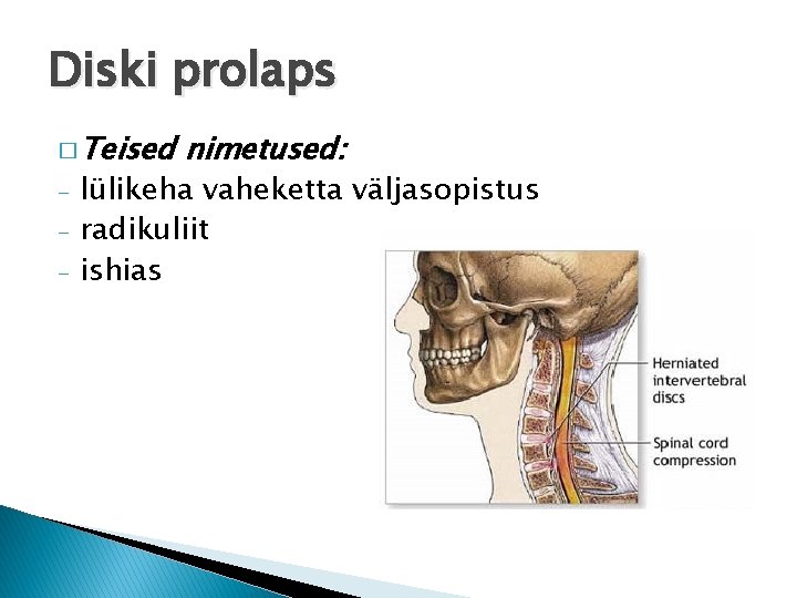 Diski prolaps � Teised - nimetused: lülikeha vaheketta väljasopistus radikuliit ishias 