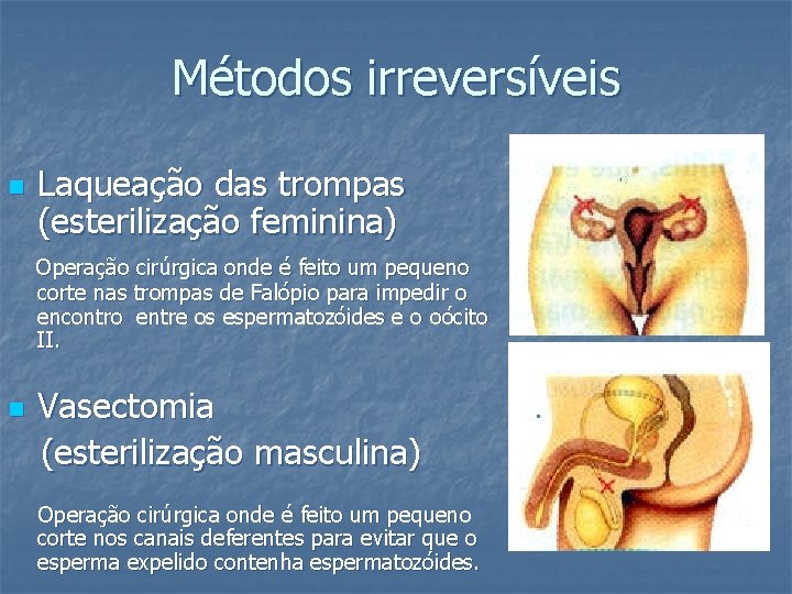 Métodos irreversíveis n Laqueação das trompas (esterilização feminina) Operação cirúrgica onde é feito um