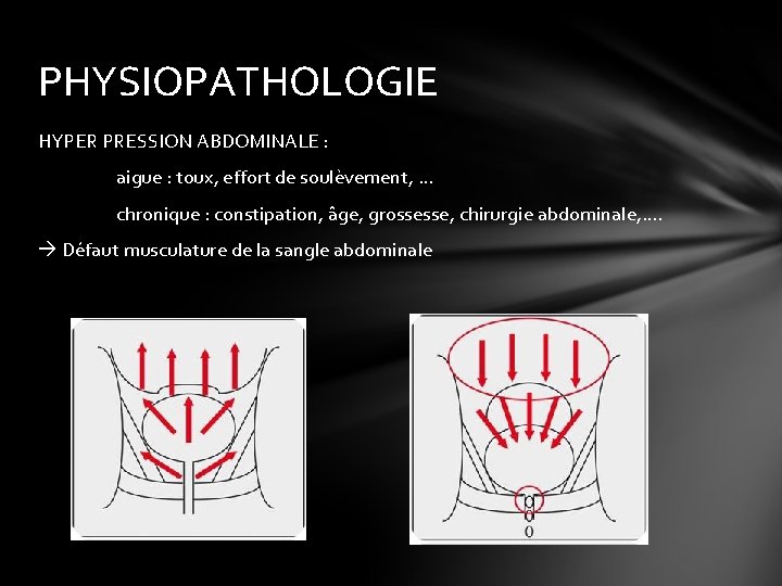 PHYSIOPATHOLOGIE HYPER PRESSION ABDOMINALE : aigue : toux, effort de soulèvement, … chronique :