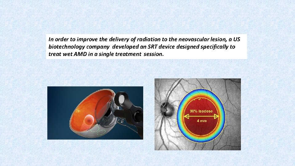 In order to improve the delivery of radiation to the neovascular lesion, a US