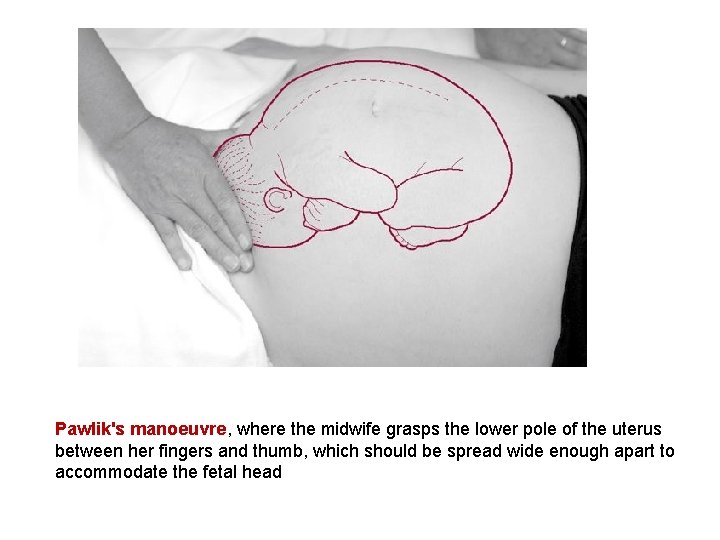 Pawlik's manoeuvre, where the midwife grasps the lower pole of the uterus between her