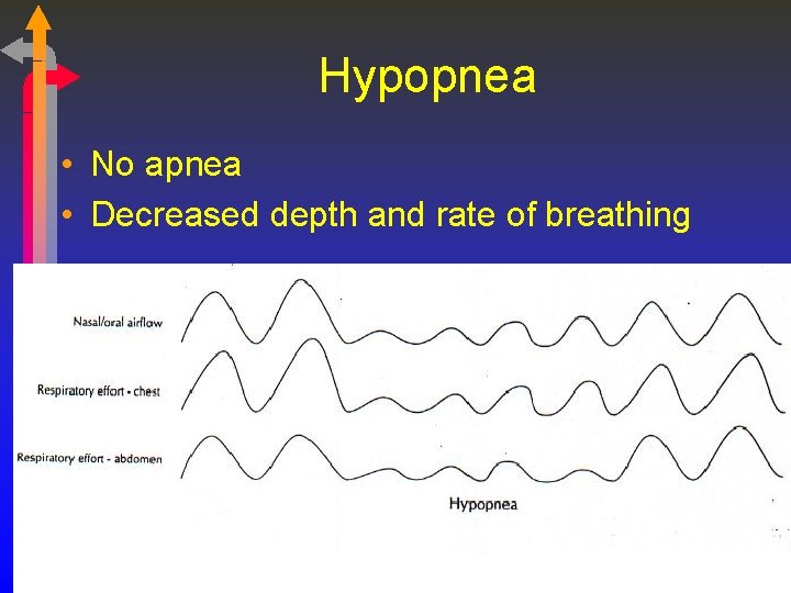 Hypopnea • No apnea • Decreased depth and rate of breathing 