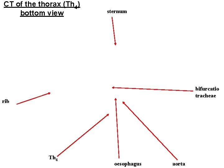 CT of the thorax (Th 4) bottom view sternum bifurcatio tracheae rib Th 4
