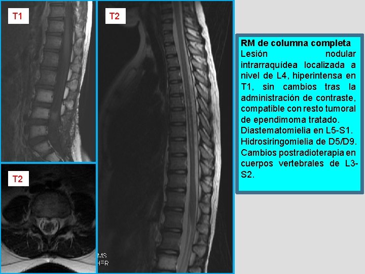 T 1 T 2 RM de columna completa Lesión nodular intrarraquídea localizada a nivel