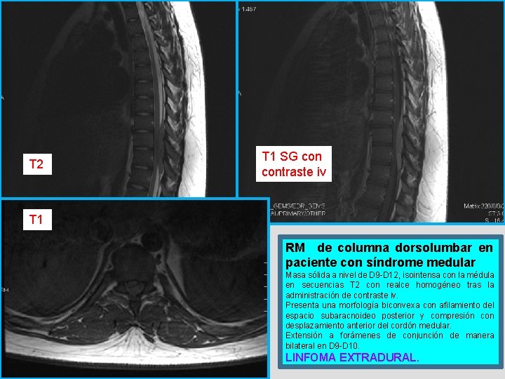 T 2 T 1 SG contraste iv T 1 RM de columna dorsolumbar en