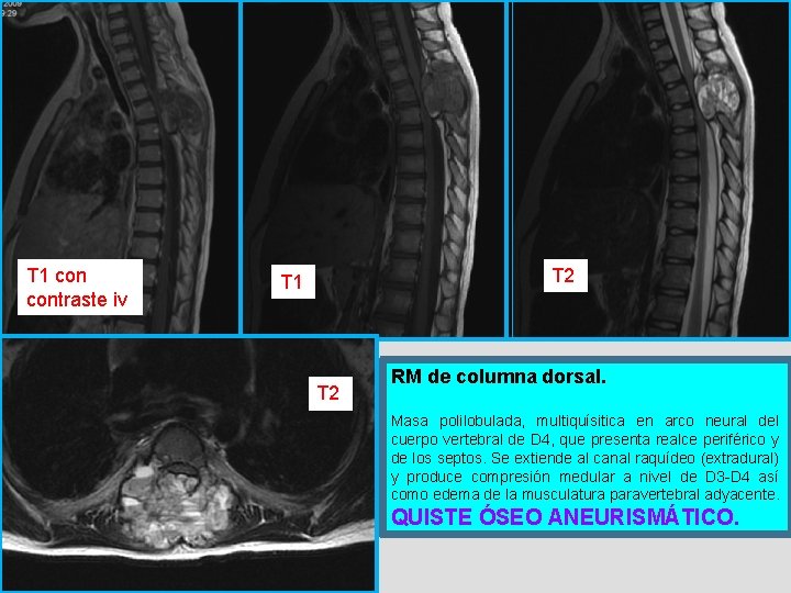 T 1 contraste iv T 2 T 1 T 2 RM de columna dorsal.