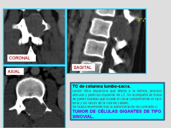 CORONAL AXIAL SAGITAL TC de columna lumbo-sacra. Lesión lítica expansiva que afecta a la