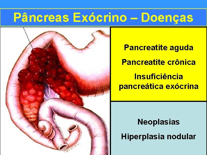 Pâncreas Exócrino – Doenças Pancreatite aguda Pancreatite crônica Insuficiência pancreática exócrina Neoplasias Hiperplasia nodular