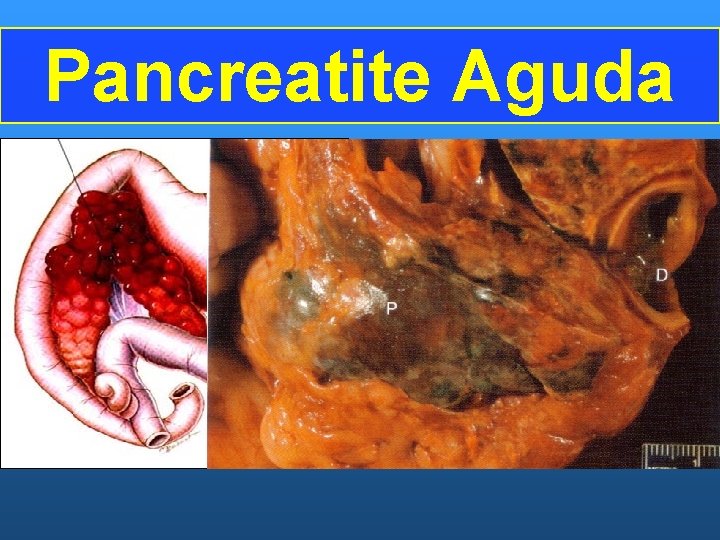 Pancreatite Aguda 