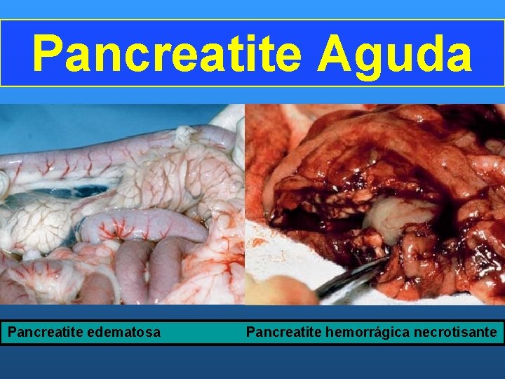 Pancreatite Aguda Pancreatite edematosa Pancreatite hemorrágica necrotisante 