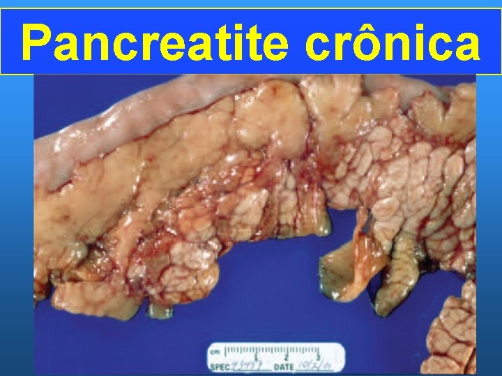 Pancreatite crônica 