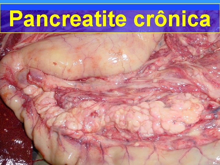 Pancreatite crônica 