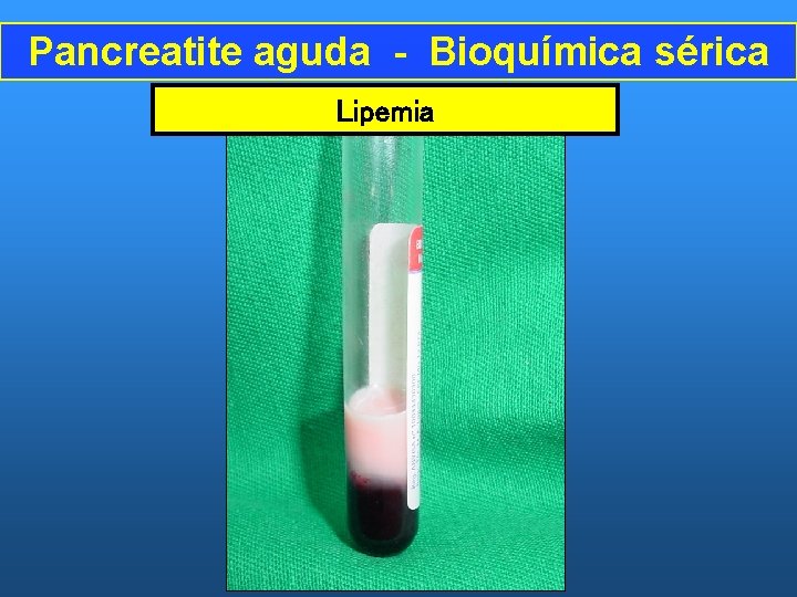 Pancreatite aguda - Bioquímica sérica Lipemia 