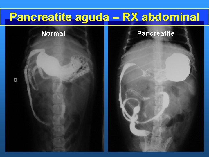 Pancreatite aguda – RX abdominal Normal Pancreatite 