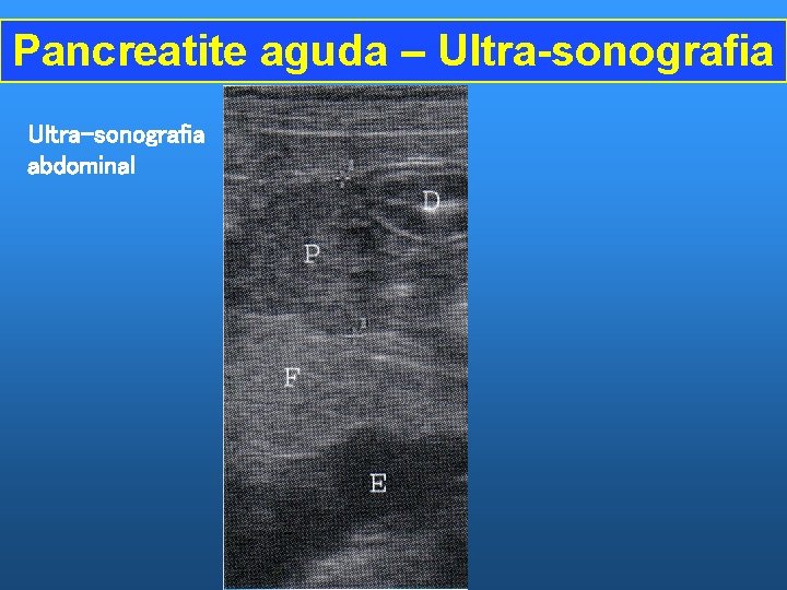 Pancreatite aguda – Ultra-sonografia abdominal 
