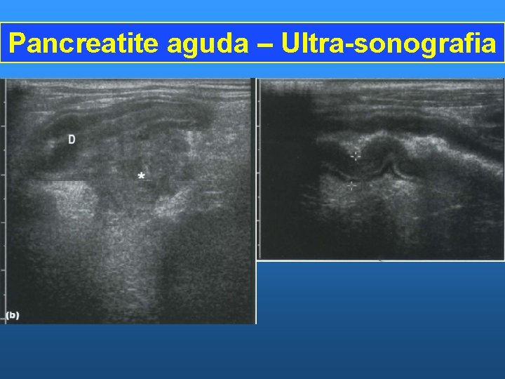 Pancreatite aguda – Ultra-sonografia 