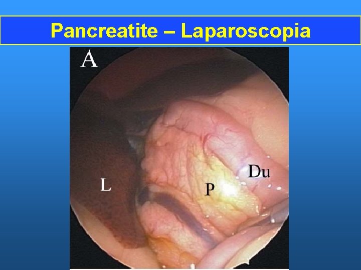 Pancreatite – Laparoscopia 