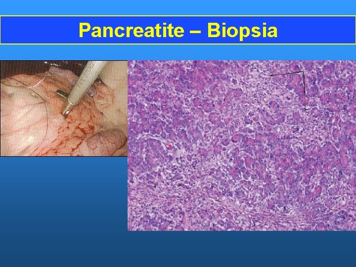 Pancreatite – Biopsia 