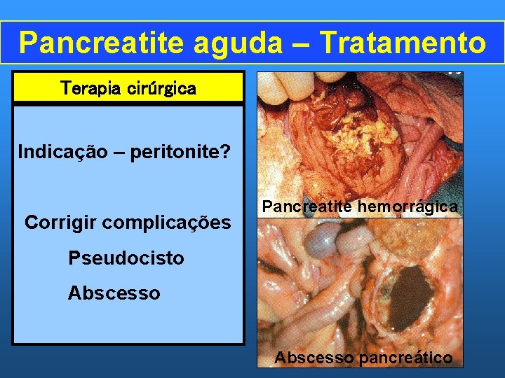 Pancreatite aguda – Tratamento Terapia cirúrgica Indicação – peritonite? Corrigir complicações Pancreatite hemorrágica Pseudocisto