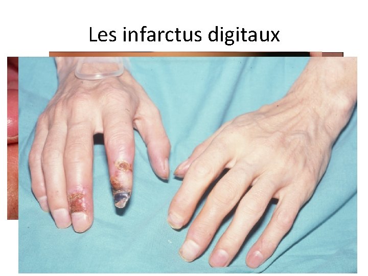 Les infarctus digitaux 