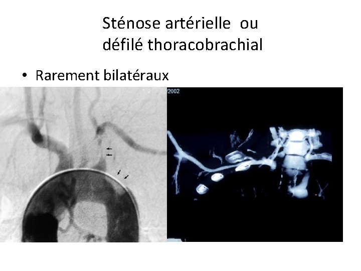 Sténose artérielle ou défilé thoracobrachial • Rarement bilatéraux 