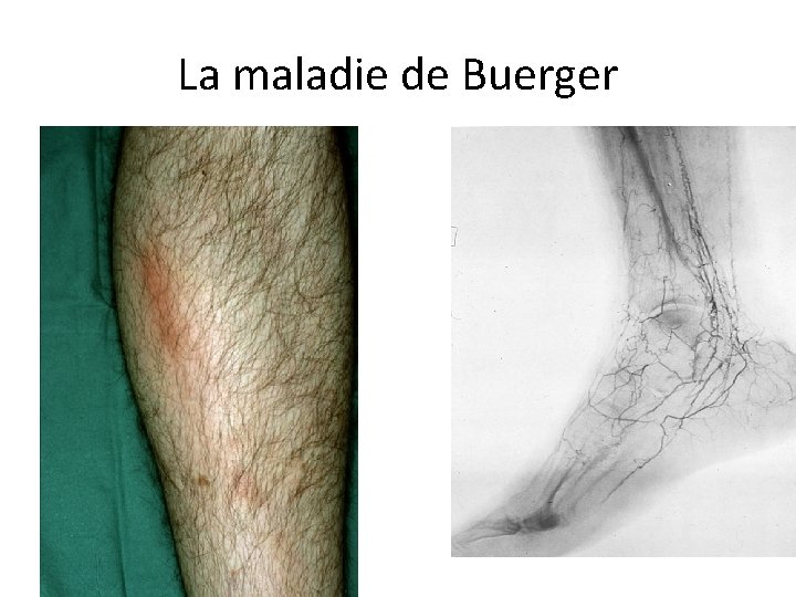 La maladie de Buerger 