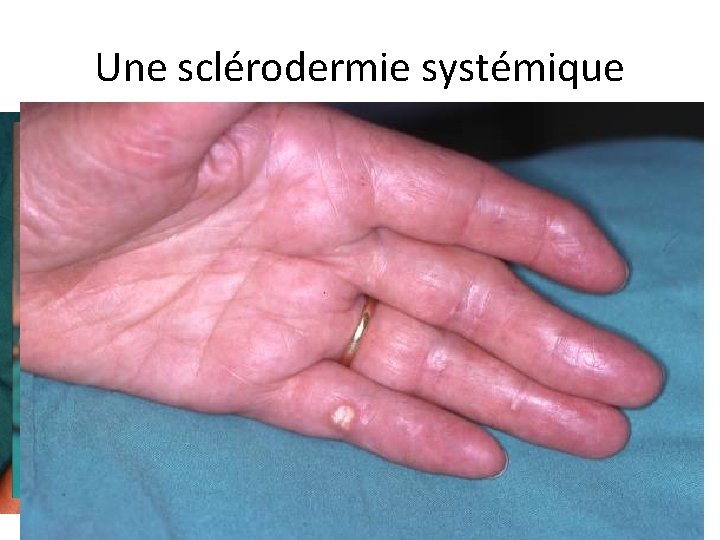 Une sclérodermie systémique 