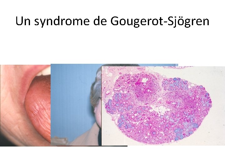 Un syndrome de Gougerot-Sjögren 