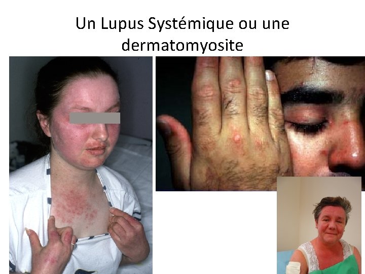 Un Lupus Systémique ou une dermatomyosite 