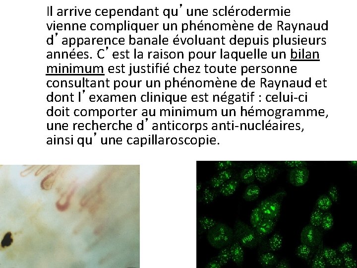 Il arrive cependant qu’une sclérodermie vienne compliquer un phénomène de Raynaud d’apparence banale évoluant