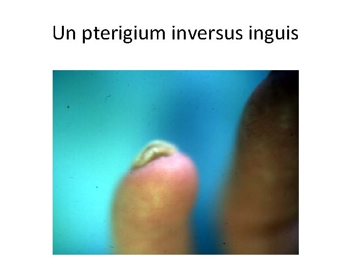 Un pterigium inversus inguis 