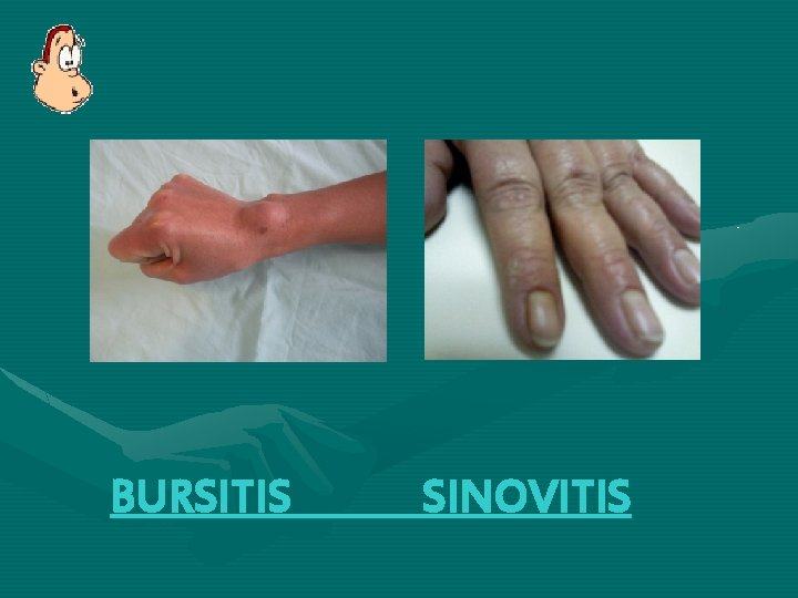BURSITIS SINOVITIS BURSITIS SINOVITIS