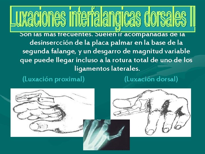 Son las más frecuentes. Suelen ir acompañadas de la desinsercción de la placa palmar Son las más frecuentes. Suelen ir acompañadas de la desinsercción de la placa palmar