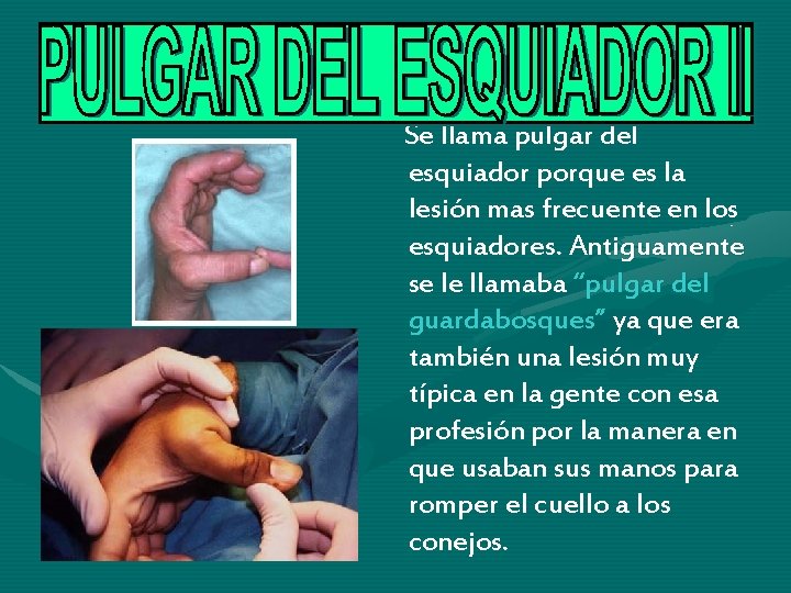 Se llama pulgar del esquiador porque es la lesión mas frecuente en los esquiadores. Se llama pulgar del esquiador porque es la lesión mas frecuente en los esquiadores.