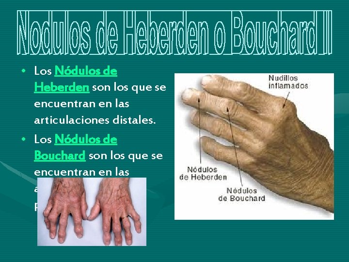 • Los Nódulos de Heberden son los que se encuentran en las articulaciones • Los Nódulos de Heberden son los que se encuentran en las articulaciones