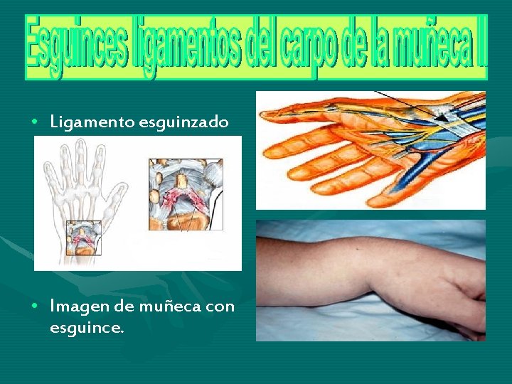 • Ligamento esguinzado • Imagen de muñeca con esguince. • Ligamento esguinzado • Imagen de muñeca con esguince.