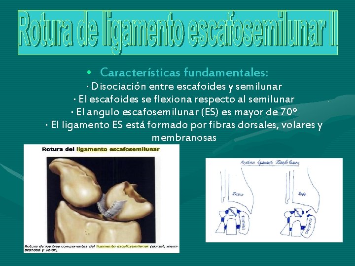 • Características fundamentales: · Disociación entre escafoides y semilunar · El escafoides se • Características fundamentales: · Disociación entre escafoides y semilunar · El escafoides se