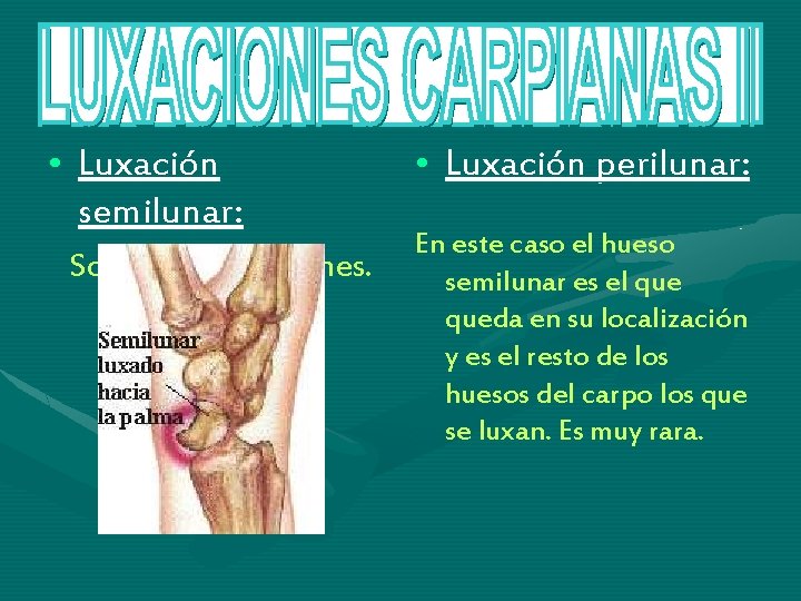 • Luxación semilunar: Son las mas comunes. • Luxación perilunar: En este caso • Luxación semilunar: Son las mas comunes. • Luxación perilunar: En este caso