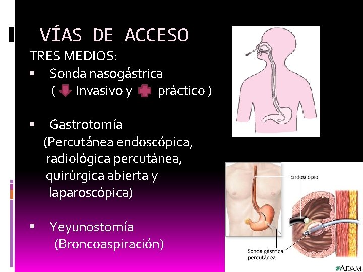 VÍAS DE ACCESO TRES MEDIOS: Sonda nasogástrica ( Invasivo y práctico ) Gastrotomía (Percutánea