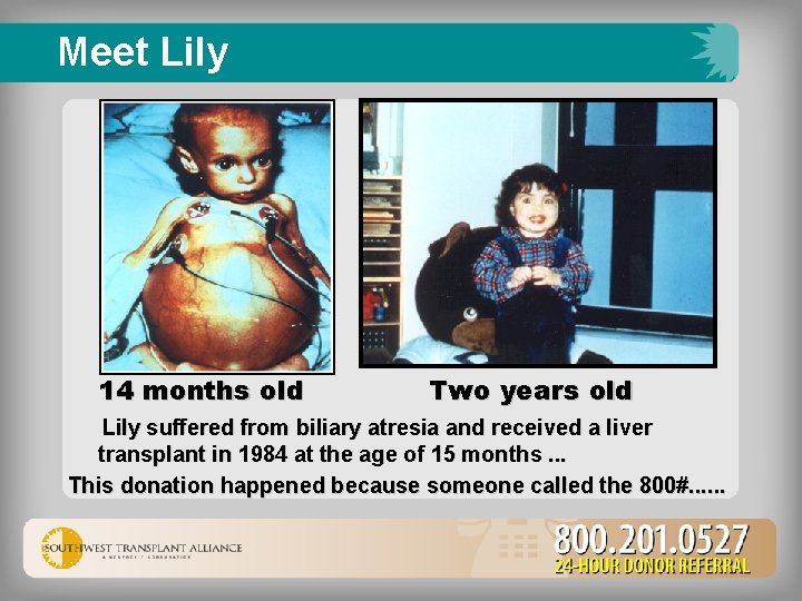 Meet Lily 14 months old Two years old Lily suffered from biliary atresia and
